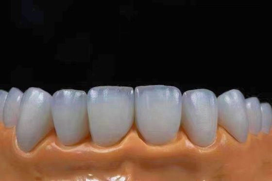kopen Hoogtranslucent Esthetische Zirconia Kronen Precies Geschikt met een Natuurlijke Look online vervaardiging