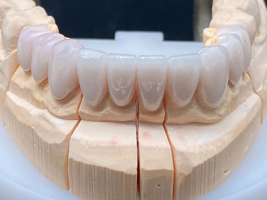 kopen Tandheelkundig laboratorium E Max Keramische kroon hoogtranslucent met corrosiebestendigheid online vervaardiging