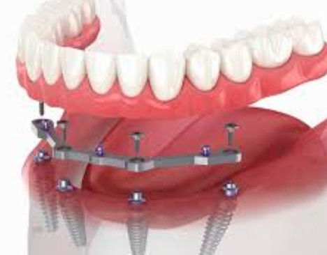 kopen Volledige boog gefreesde titaniumbalk tandheelkundige 12mm lengte met 2+ aanhangsels online vervaardiging