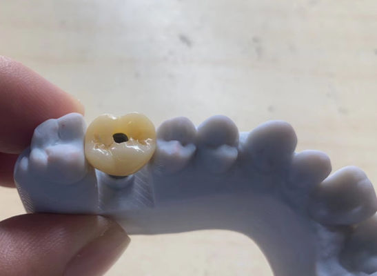 Hoge precisie Implantate ondersteunde kroon Stabiel en eenvoudig onderhoud