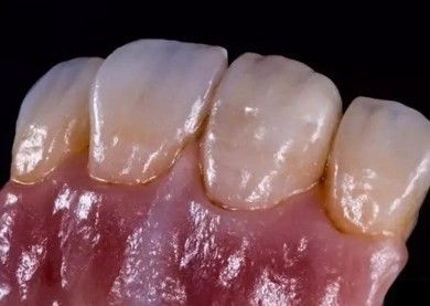 Duitse Amanjilbach Zirconia tandheelkundige kroon