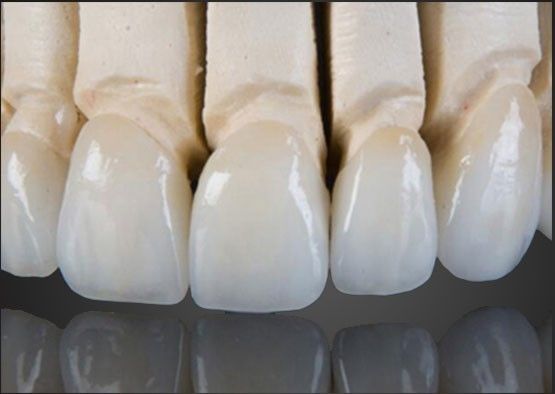 Wieland Zirconia Alle keramische kroon Interieur schilderen op maat met CAD-ontwerp