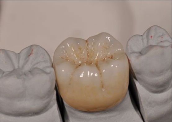 Hoge esthetiek Noritake Zirconia Natuurlijke kleur Stabiel voor volledige Zirconia kroon