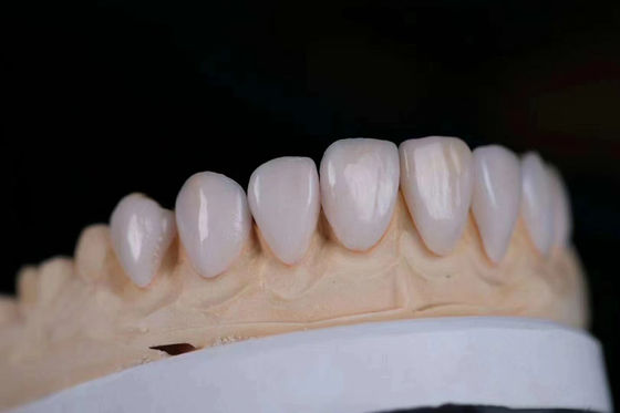 Hoge esthetiek Tandheelkundige lab kronen Porselein gelaagd Zirconia Vlekwerend