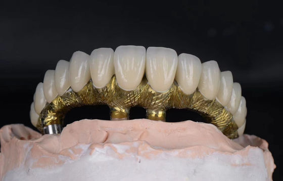 Titanium legering tandheelkundige implantaten en kronen natuurlijke uitstraling met corrosiebestendig