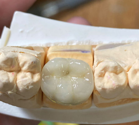 Precieze, esthetische en sterke tandheelkundige PFM porselein gesmolten met een metalen kroon in de tandheelkunde