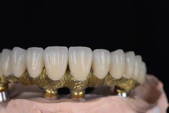 Natuurlijk uitziende kroon porselein gesmolten met metaal met hoge precisie voor tandheelkundige implantaten