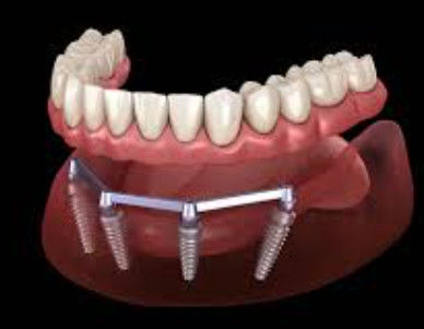 Zandgeblazen tandheelkundige implantaten voor doorschijnende en natuurlijke esthetiek